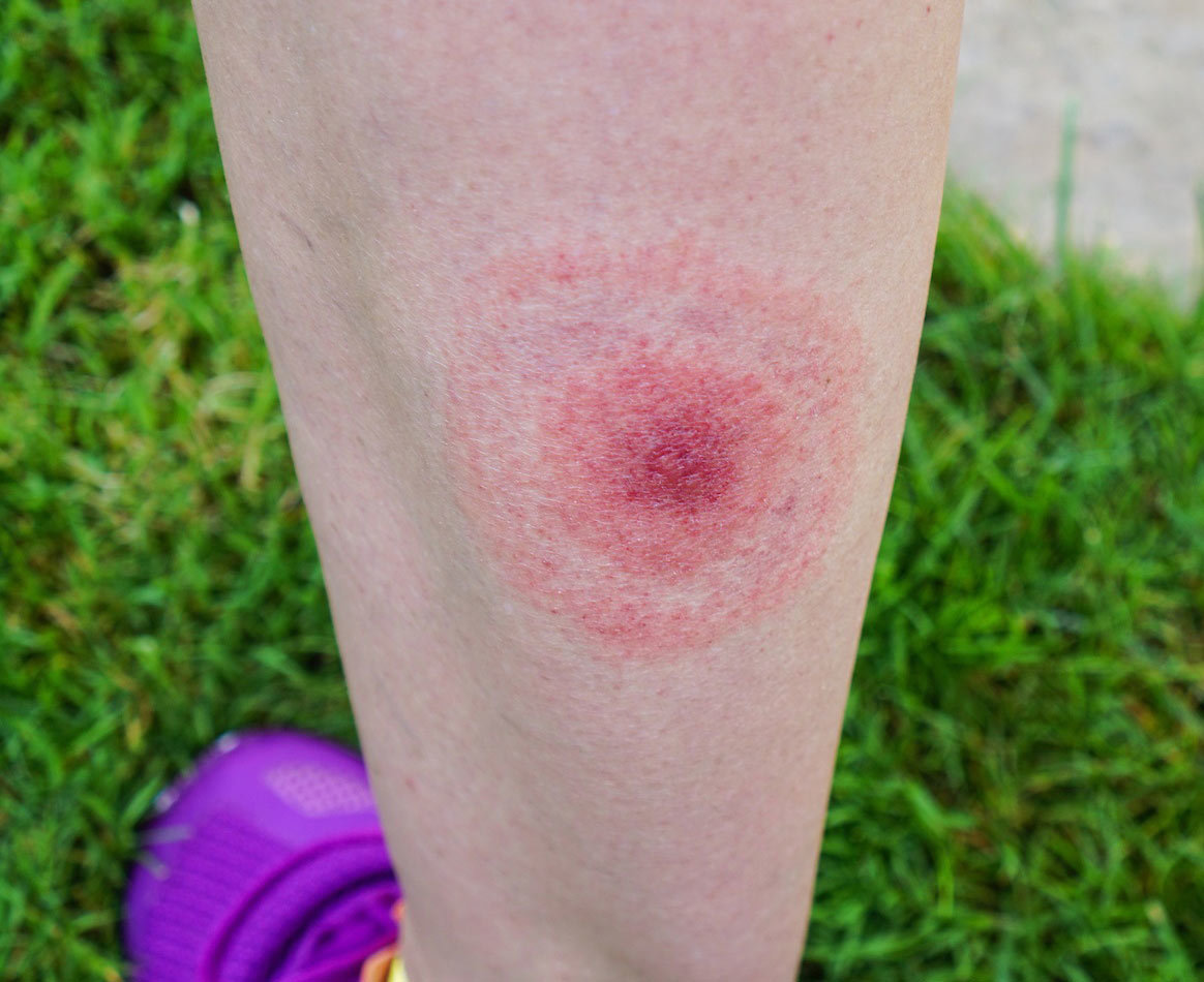 UMM_lyme-rash_sized.jpg#asset:118464