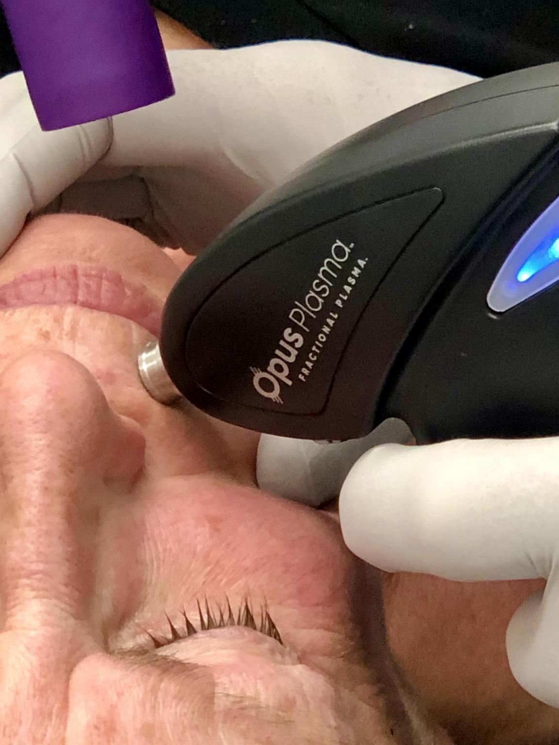 Before and after opus™ photos Getting Under the Skin - Baltimore Magazine